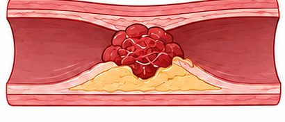 죽상반이 터진 자리에 붉은 피떡이 엉겨 혈관을 막은 그림